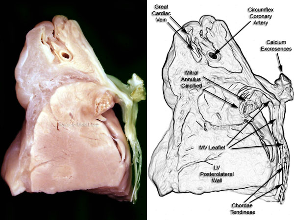 MV Annular Calcification